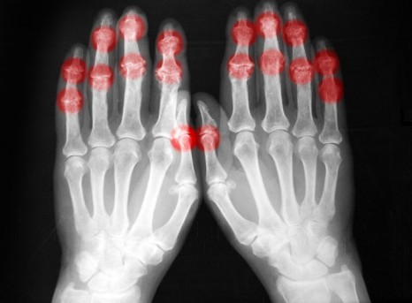 Arthroscopic Finger Synovectomy by OrangeCountySurgeons